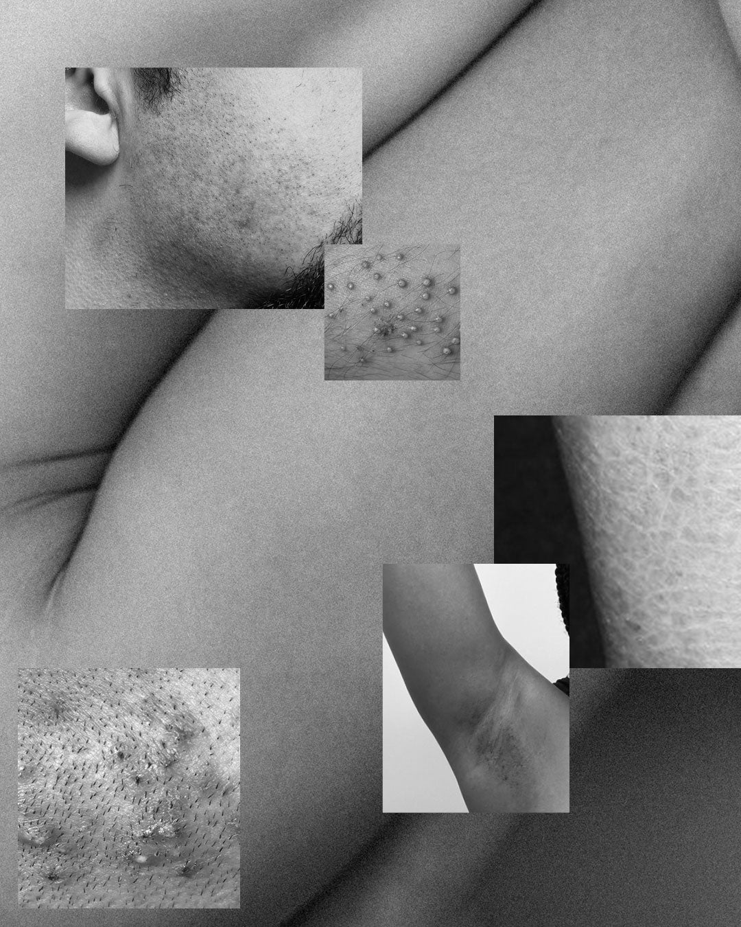 Why shaving causes irritation: razor burn, ingrown hairs and more